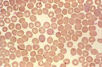 Babesiosis (or piroplasmosis)