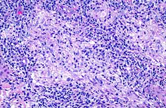 Leishmaniasis causada por Leishmania infantum