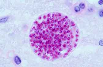 Toxoplasmosis caused by Toxoplasma gondii